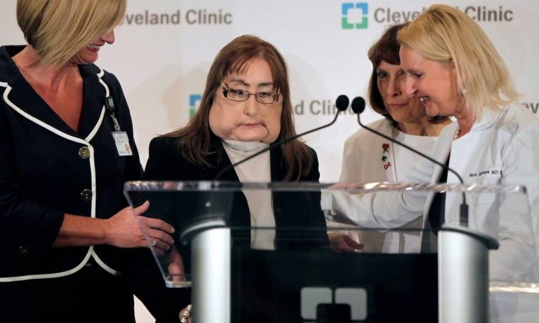 HΠΑ: Πέθανε η πρώτη Αμερικανίδα που έκανε μεταμόσχευση προσώπου